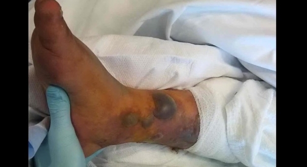Paciente internado com infecção após tatuagem e banho de m