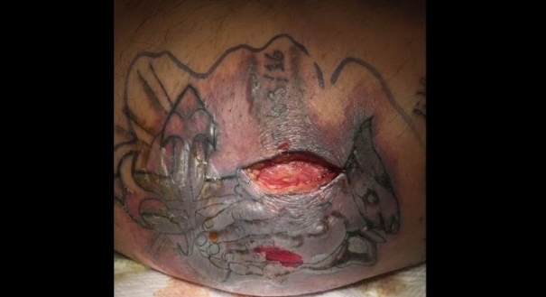 Paciente internado com infecção após tatuagem e banho de mar