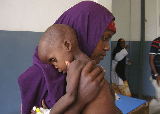 Lul Ibrahim, de dois anos, recebe tratamento médico por desnutrição em um hospital de Mogadício, Somália. Crédito: Farah Abdi Warsameh