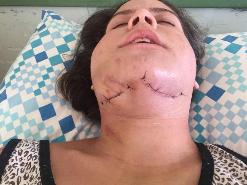Géssica passou por cirurgia no maxilar após as agressões sofridas em uma festa em Nova Venécia. Crédito: Arquivo pessoal