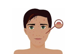 Acne. Crédito: Shutterstock