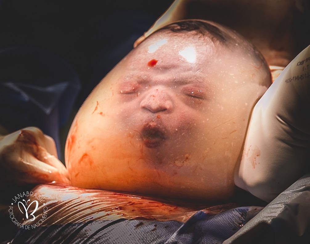 Bebê empelicado bomba na web ao nascer fazendo biquinho e careta no ES. Crédito: Jana Brasil